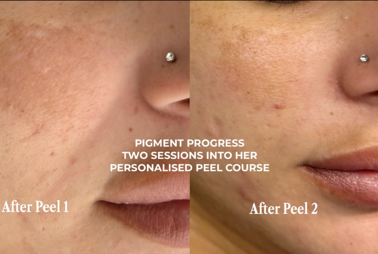 Pigment Correction Peel