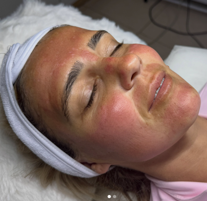 Immediately after skin needling. Redness is expected and settles within a few days